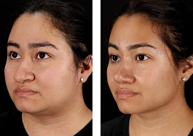 icon for Facial Liposuction